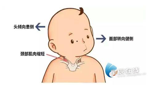斜颈图片,从成因到康复之路