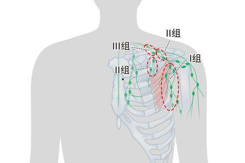 腋下淋巴结图片,揭秘人体免疫系统的重要关卡