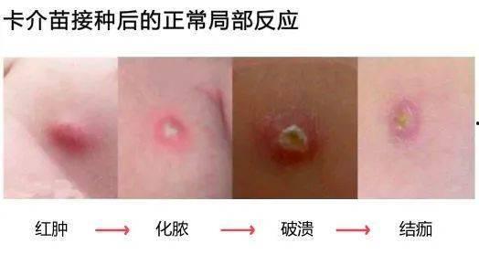 卡介苗接种失败图片,探究原因与预防措施
