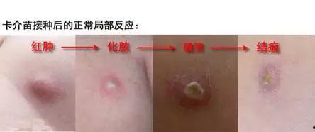 卡介苗接种失败图片,探究原因与预防措施