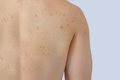 艾滋病长的疹子图片,识别与预防的关键