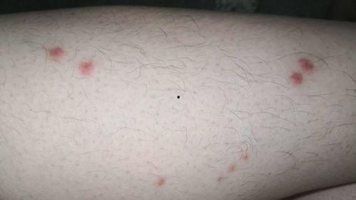 艾滋病长的疹子图片,识别与预防的关键