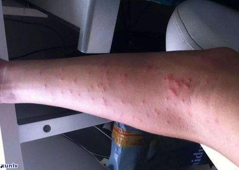 艾滋病长的疹子图片,识别与预防的关键