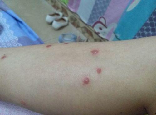 过敏起红疙瘩图片,揭秘常见症状与应对策略