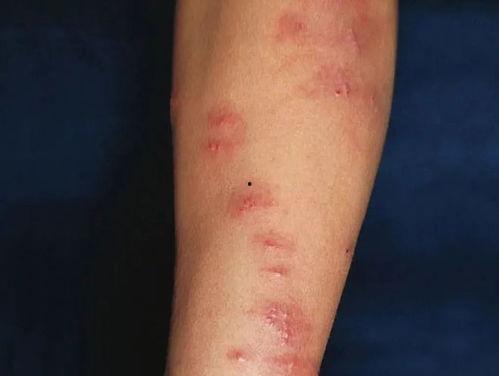 过敏起红疙瘩图片,揭秘常见症状与应对策略