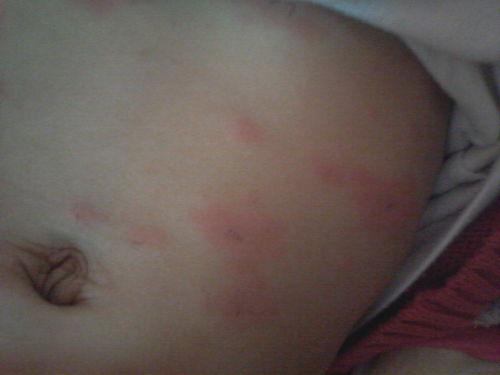 过敏起红疙瘩图片,揭秘常见症状与应对策略