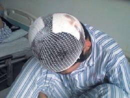 软组织损伤图片,软组织损伤病例图解与概述